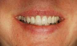 After: An Esthetic Correction